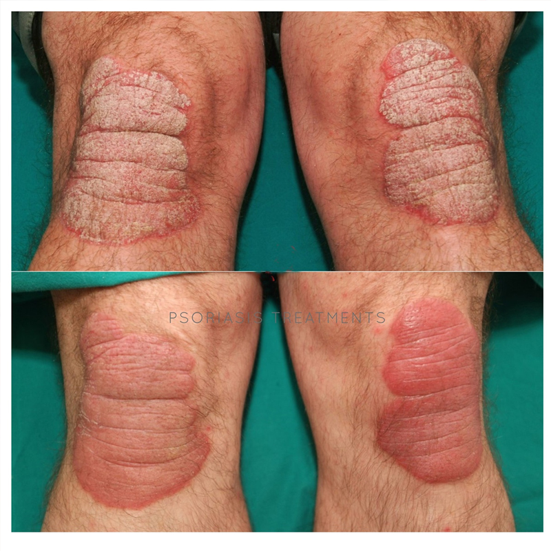 Natural Plant Extract Psoriasis Dermatitis Eczematoid Eczema Ointment Anti-Itch Chinese Herb Medical Skin Care Cream 15/30/50g