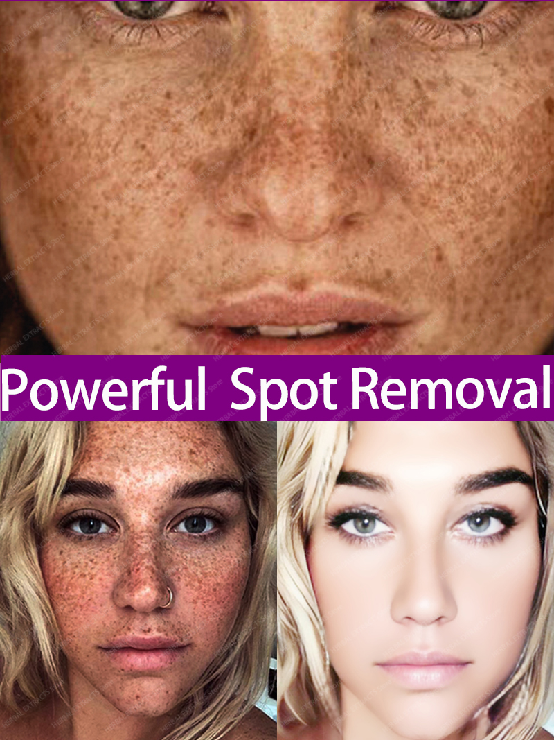 Best of Dark Spot Remover For Face Freckles Melasma Age Spots Removal Reviews & Tips