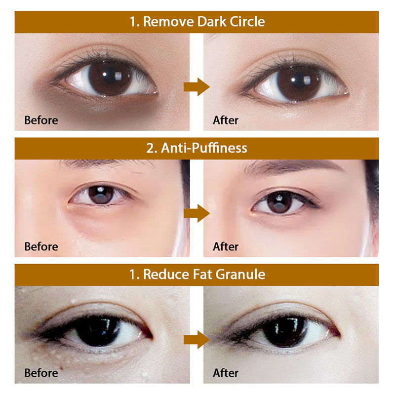 How To Get Rid Of Eyelid Creases | lupon.gov.ph