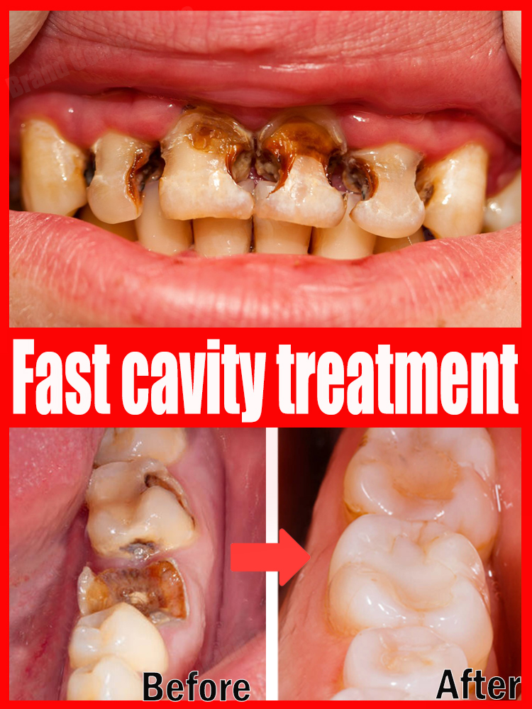 Best of Repair Tooth Decay Protect Teeth All Cavities Reviews & Tips