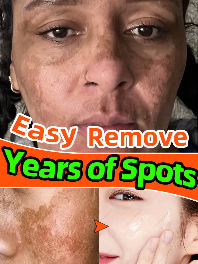 Best of Freckles Removal Cream Dark Spot Remover For Face Melasma Removal Depigmenting Reviews & Tips