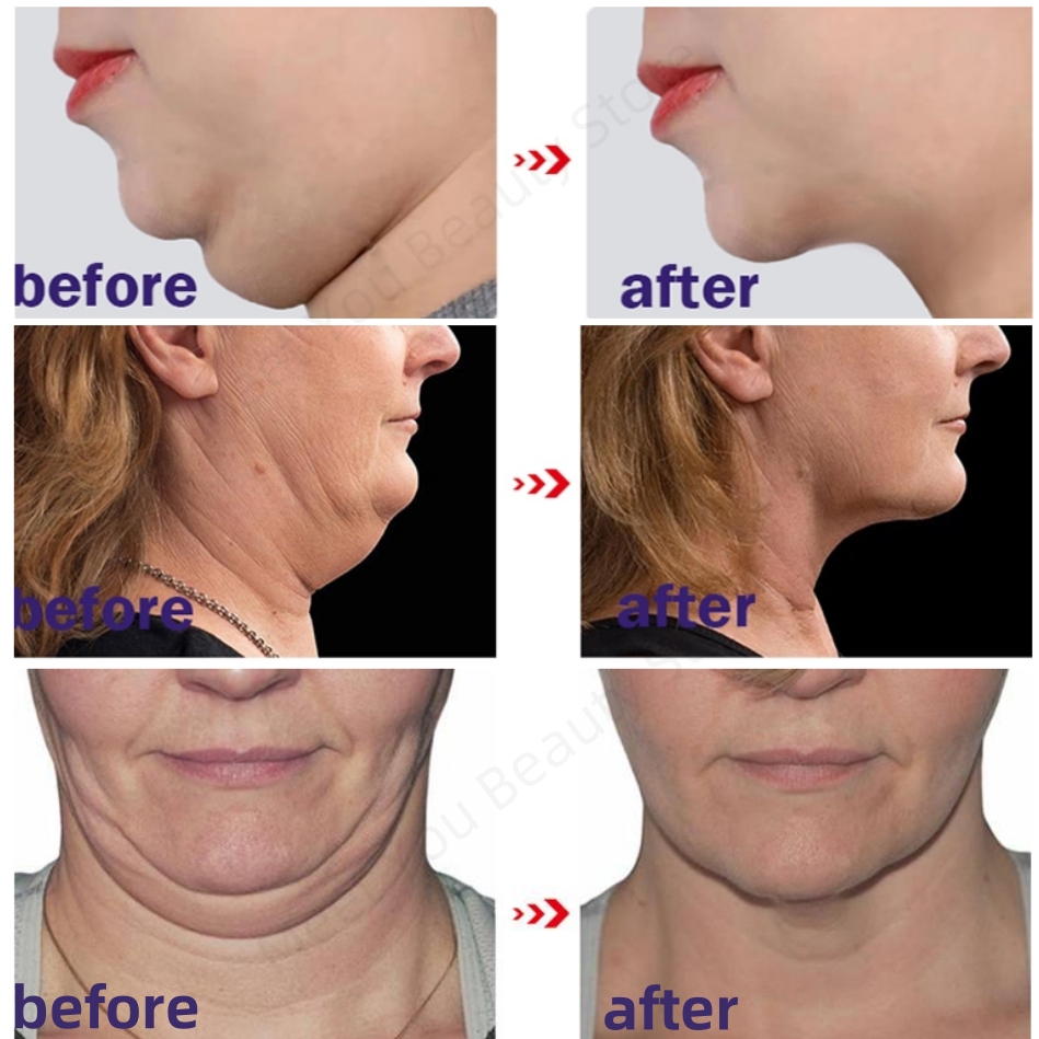 Best of V-Shape Slimming Cream Firm Face-lift Removal Double Chin Eliminate Masseter Muscle Tighten Two-Mandibular Line Anti-aging Cream Reviews & Tips - Image 3