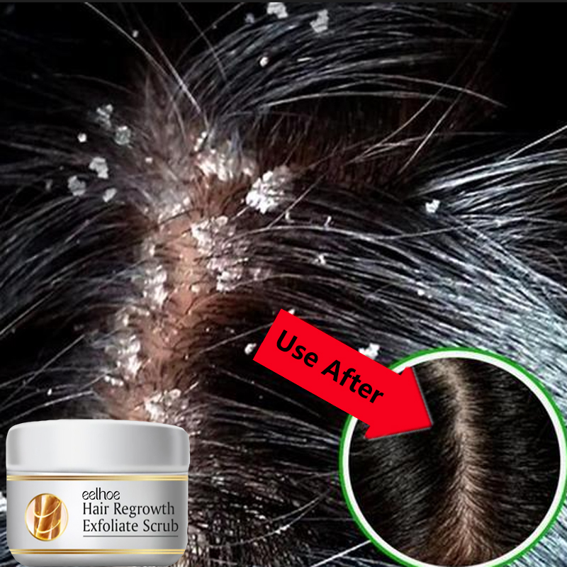 Best of Fast Anti Dandruff Hair Treatment Scrub Itching Repair Scalp Cleaning Exfoliating Products Oil Control Antipruritic Hair Care Reviews & Tips