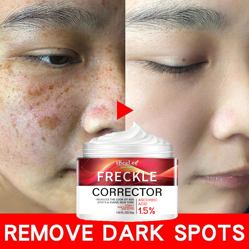 Best of Freckle Whitening Cream Black Dots Melasma Remover Anti Brown Stain Lighten Pigmentation Moisturizing Skin Care Korean Products Reviews & Tips