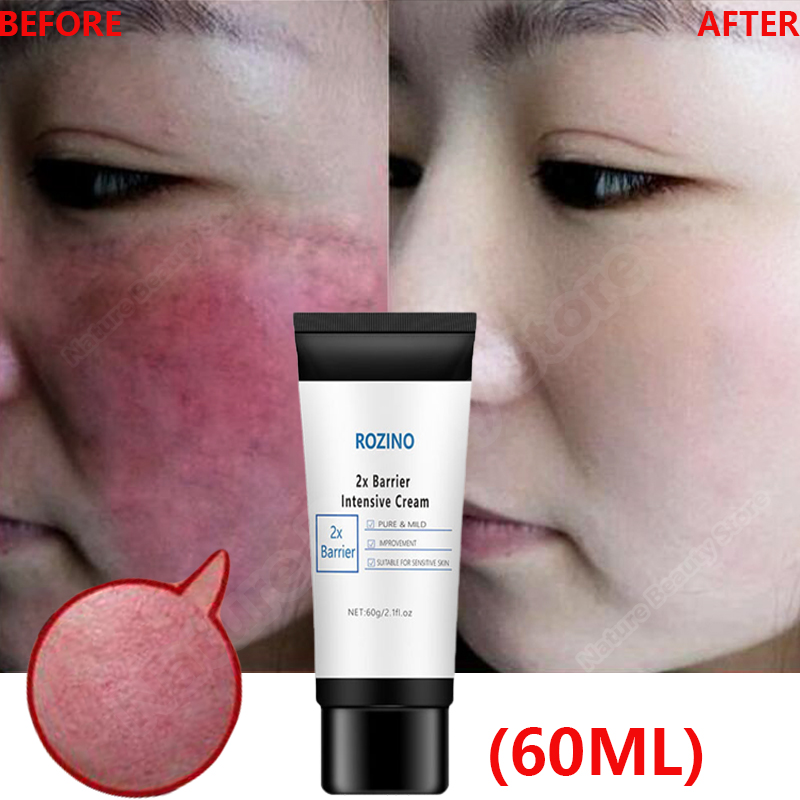 Best of Facial Redness Repair Cream Improve Sensitive Skin Redness Rosacea Itching Instant Spider Vein Treatment Anti Aging Skin Care Reviews & Tips