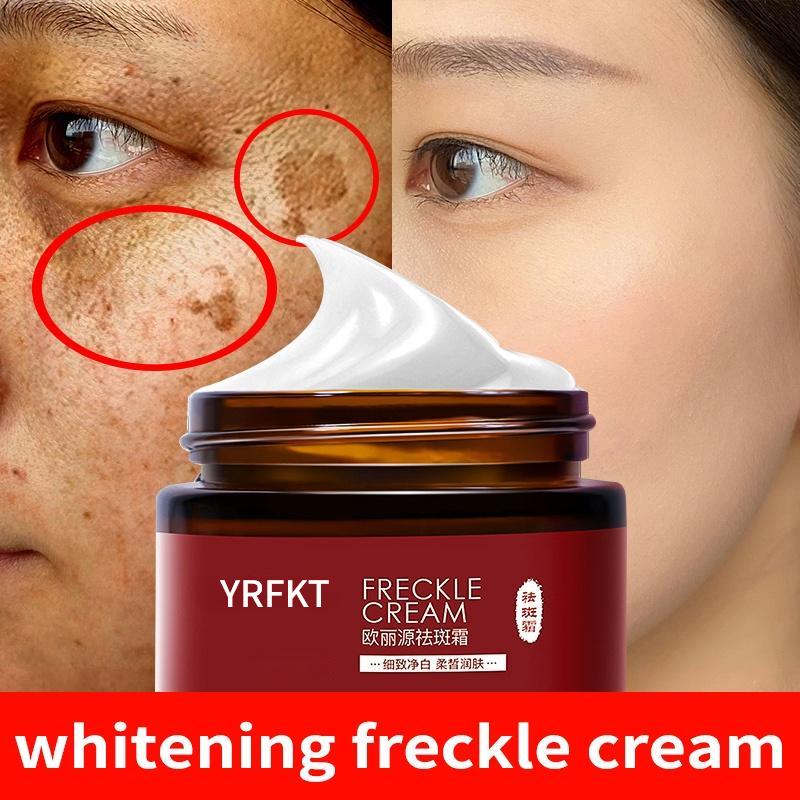 Best of Whitening Freckle Cream Remove Melasma Spot Acne Pigment Melanin Dark Spots Pigmentation Freckle Removal Cream Reviews & Tips