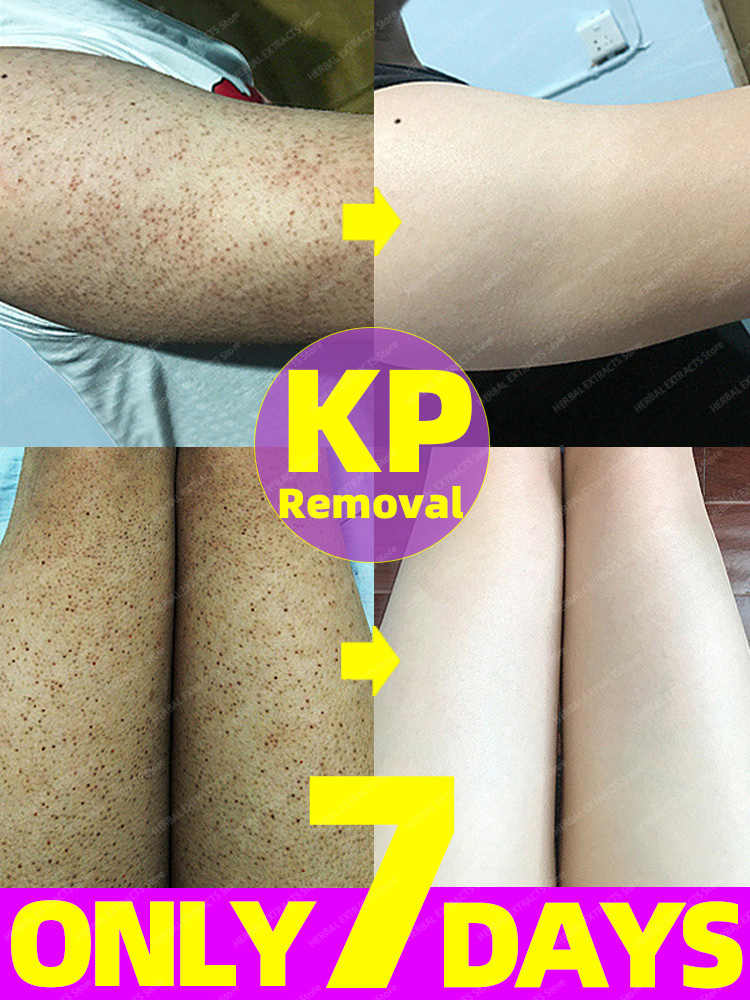 Best of Keratosis Pilaris Treatment Cream Chicken Skin Removal Strawberry Legs Dry Skin Remover Body Scrub Reviews & Tips