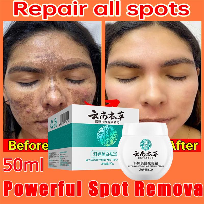 Best of Dark Spot Corrector Skin Whitening Fade Cream Lighten Blemish Removal Serum Reduces Freckles Melasma Sun Spot Brighten Skin Care Reviews & Tips