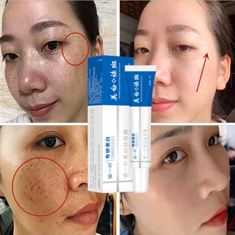 Best of Remove Freckle Whitening Cream Effective Reduce Melasma Dark Acne Spots Fade Melanin Moisturize Brighten Smooth Korean Care Skin Reviews & Tips