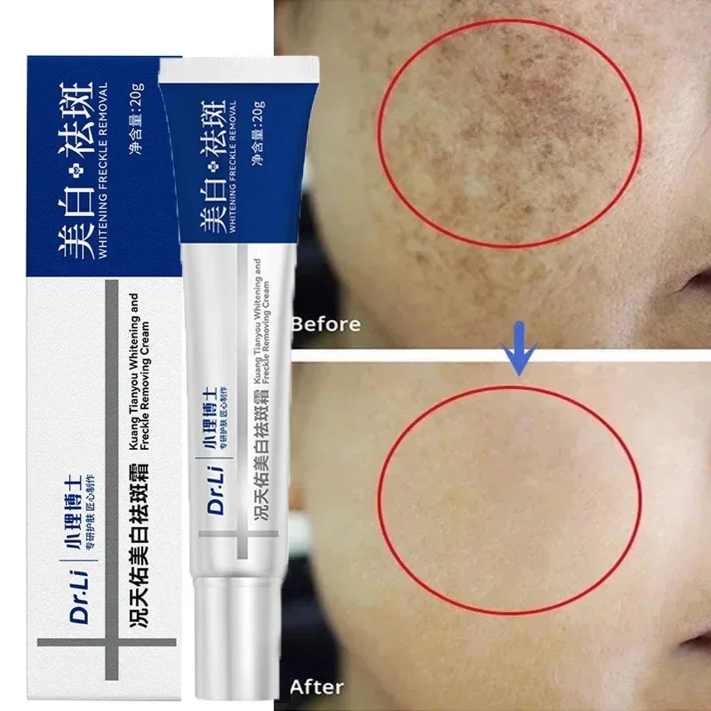 Best of Whitening Freckle Cream Remove Melasma Dark Spots Face Cream Fade Melanin Moisturize Brighten Smooth Skin Care Korean Cosmetics Reviews & Tips