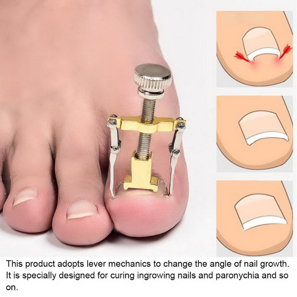 Description Picture 4 of itemNew Ingrown Toe Nail Recover Correction Tool Pedicure Toenail Fixer Foot Nail Care Tool Orthotic Nail Corrector Pedicure Tool