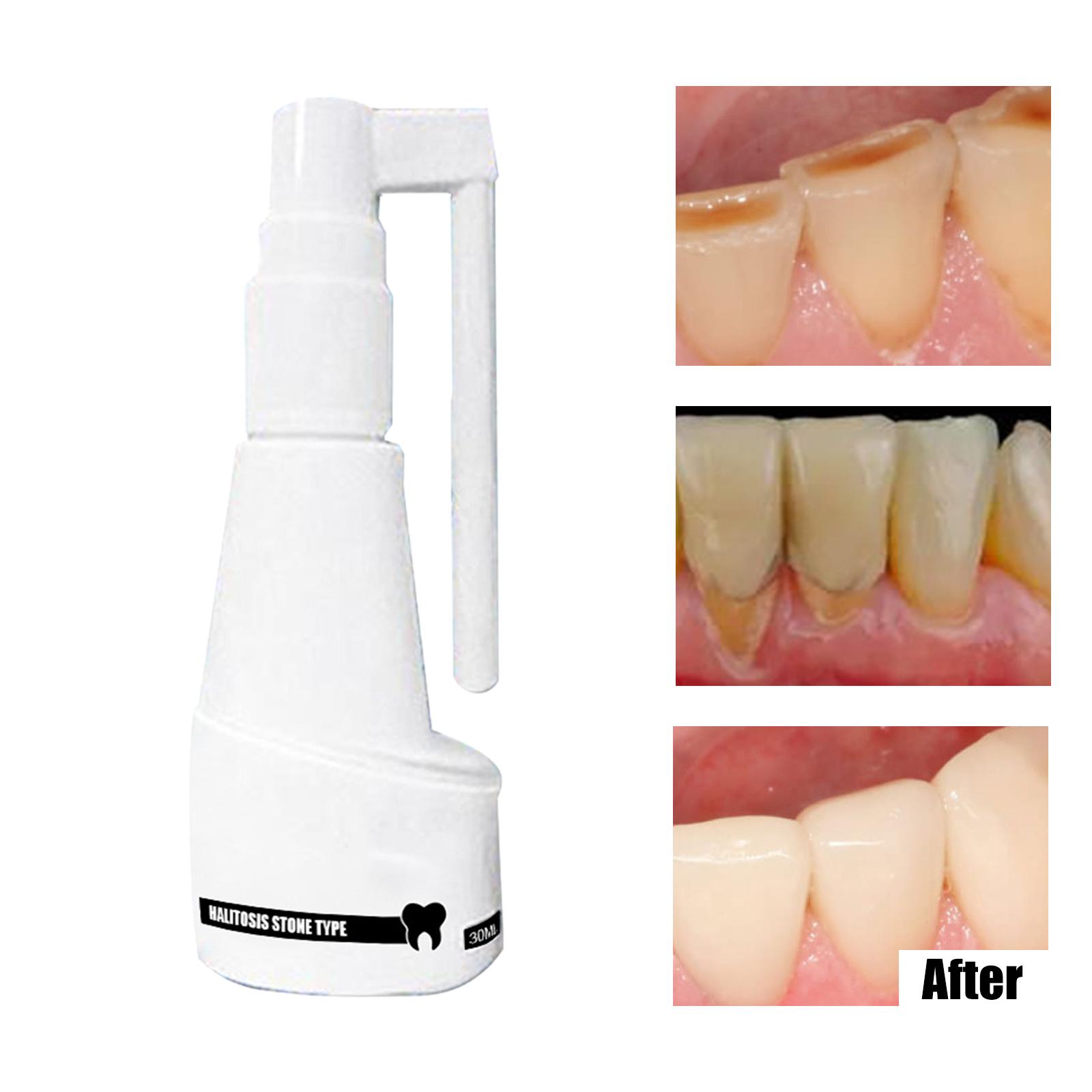 Mouth Clean Spray Antibacteria Stains Remover Tonsil Stones Fresh Breath Oral Care Mouth Freshener Bad Breath for Women Home Use