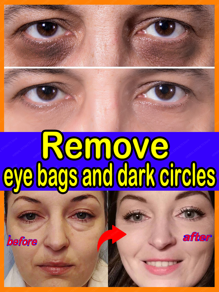 Best of Eye Cream Dark Circles And Bag Removal For Anti Bags Eyes Area Reviews & Tips