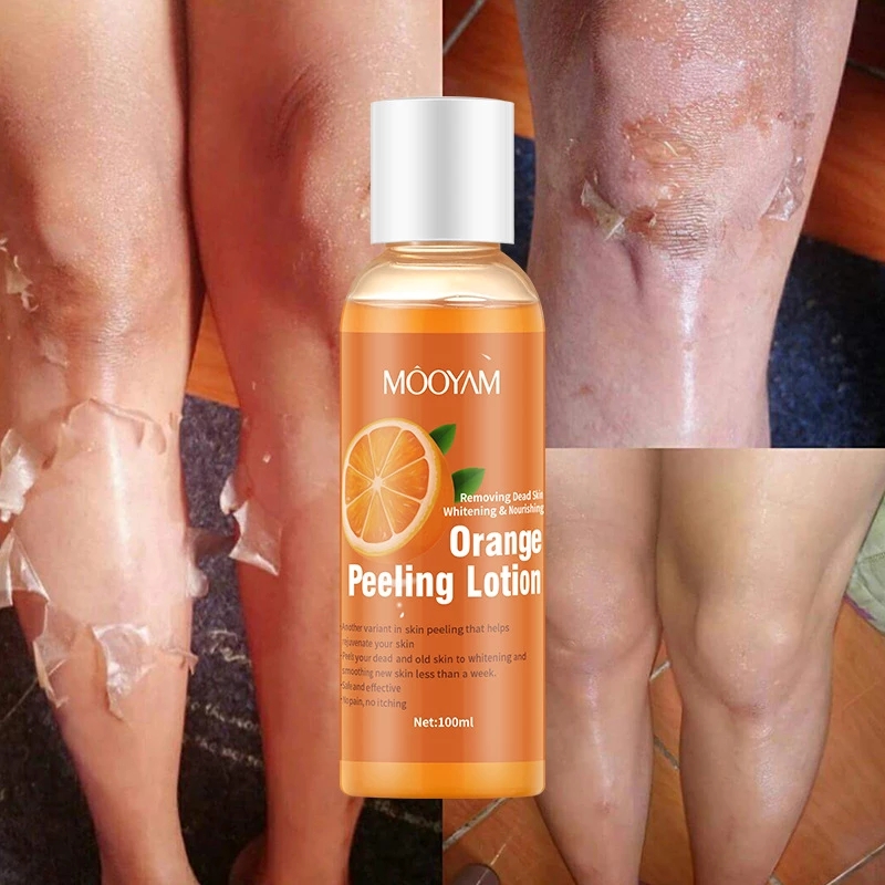 Best of Hot Orange Yellow Peeling Lotion Oil Bleaching Dark Skin Retinol Peptide Spots Blackhead Blemishes Bad Skin Spot Treatment Care Reviews & Tips