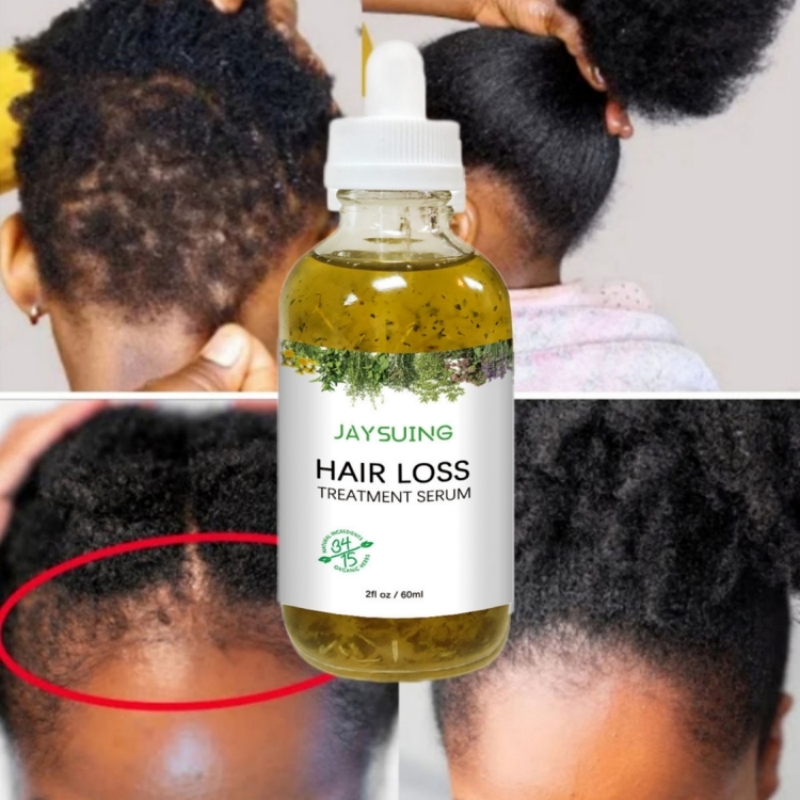 Best of Miracle Rapid Hair Growth Serum Afro Crazy Regrowth Prevent Baldness Treat Thinning Herbal Hair Growth Treatment Oil Reviews & Tips