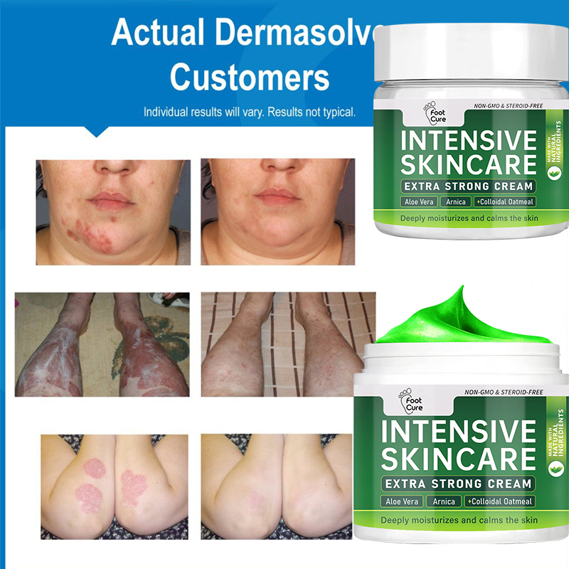 Natural Plant Extract Psoriasis Dermatitis Eczematoid Eczema Ointment Anti-Itch Chinese Herb Medical Skin Care Cream 15/30/50g