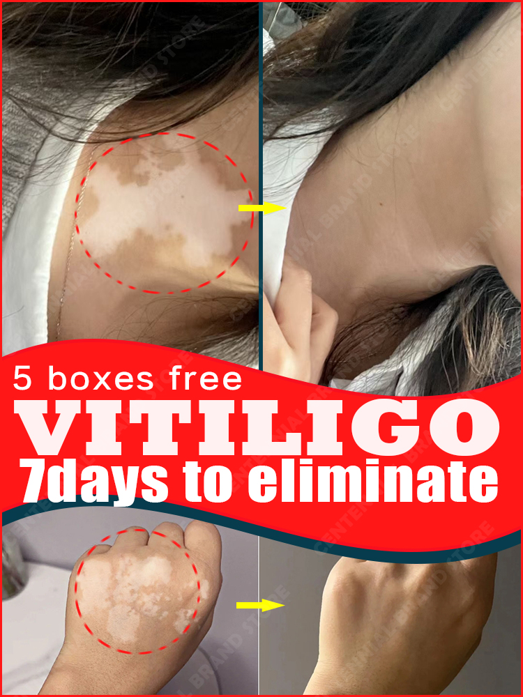 Best of Vitiligo Repair Cream Whole Body Skin White Spot Elimination Products Reviews & Tips