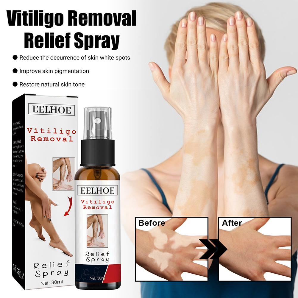 Best of 30ml Vitiligo Relief Spray Skin Moisturizing Vitiligo White Face Spray Net Repair Spot Fades Spots Vitiligo Body Repair Ski E5X2 Reviews & Tips - Image 3