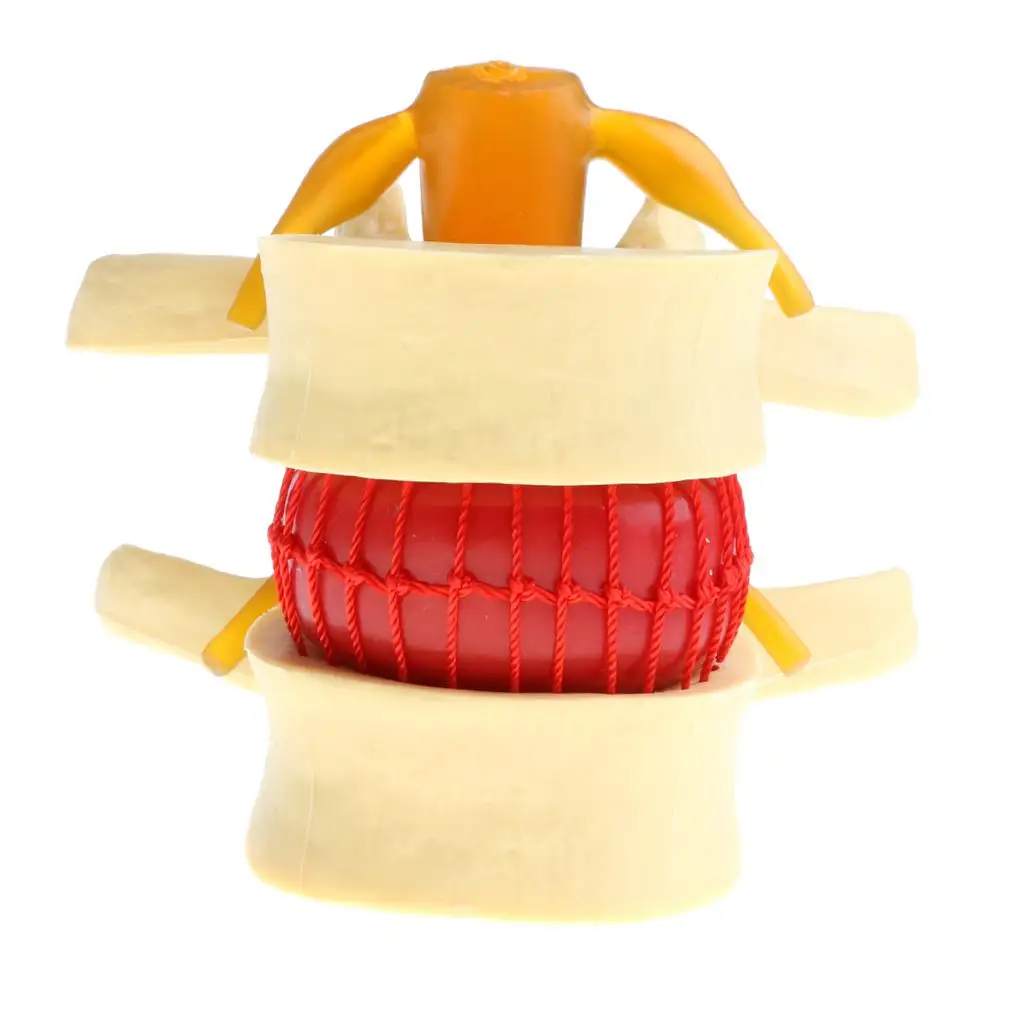  Human Spine  Vertebrae Degenerative  Disc Herniation Demonstration Model,  Teaching Tools, Magnified 2 Times