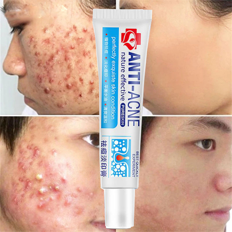 Best of Herbal Anti Effective Acne Removal Cream Traditional Chinese Medicine Treatment Shrink Pores Spots Gel Whitening Moisturizing Reviews & Tips