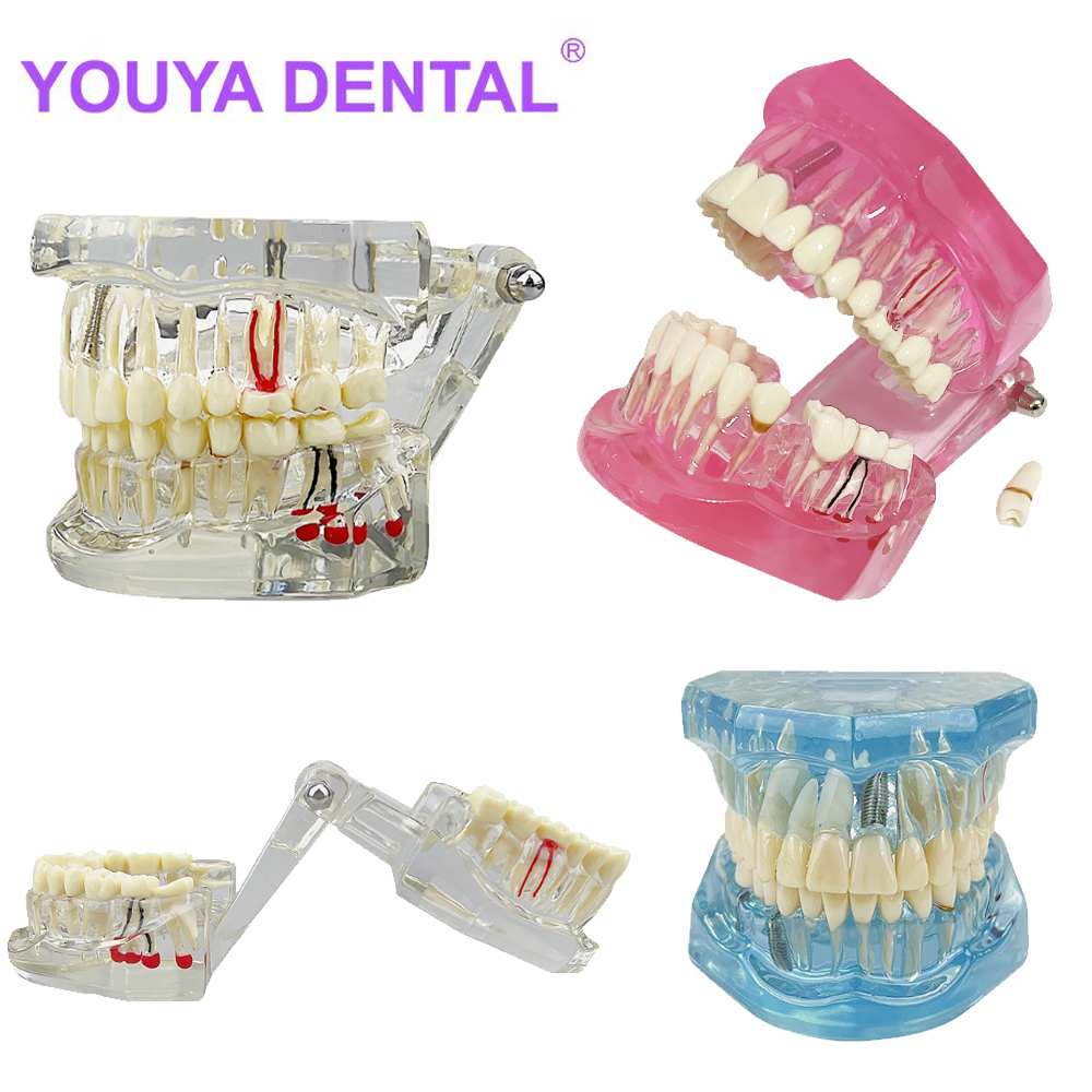 Best of Dental Model Teeth Implant Restoration Bridge Teaching Study Medical Science Disease Analysis Model Dentist Dentistry Materials Reviews & Tips