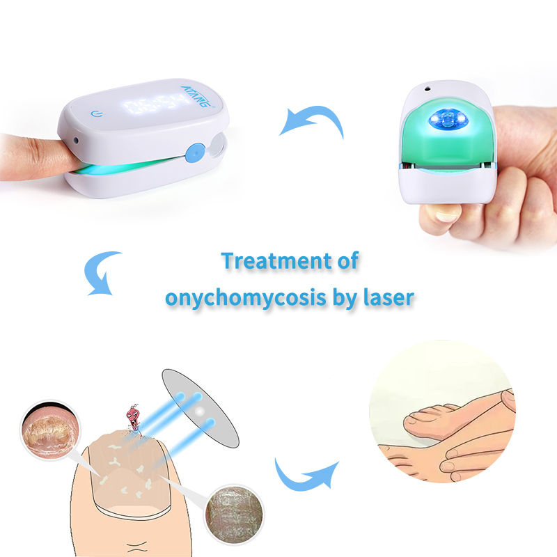 Best of 905NM Cold Laser Nail Fungus Laser Treatment Device Nail Cleaner Therapy Equipment Toe Finger Fungal Remover Onychomycosis Reviews & Tips