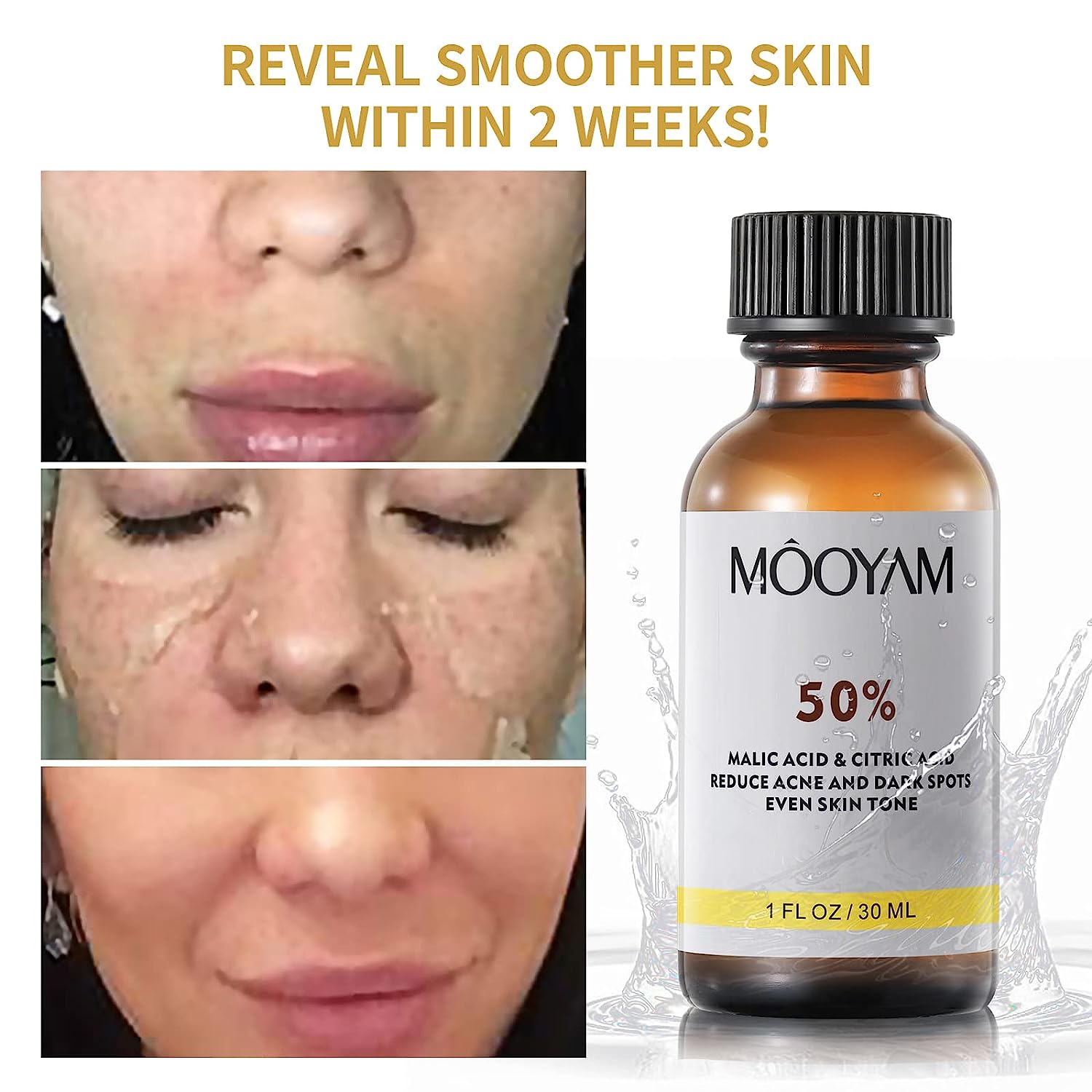 Best of TCA 50% Acid Skin Peel Salicylic Acid Skin Peel Care Peeling Wrinkles Spots Skin Care Face Serum Reviews & Tips