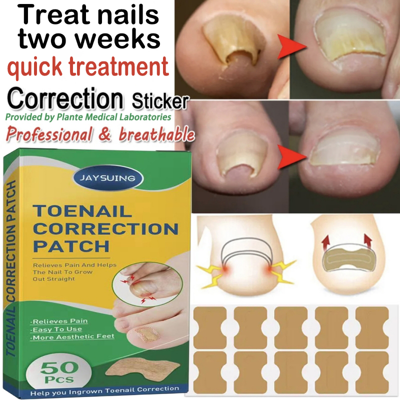 Best of 50pcs Nail Correction Stickers Ingrown Toenail Corrector Patches Paronychia Treatment Recover Relieve Nail Involution Foot Care Reviews & Tips