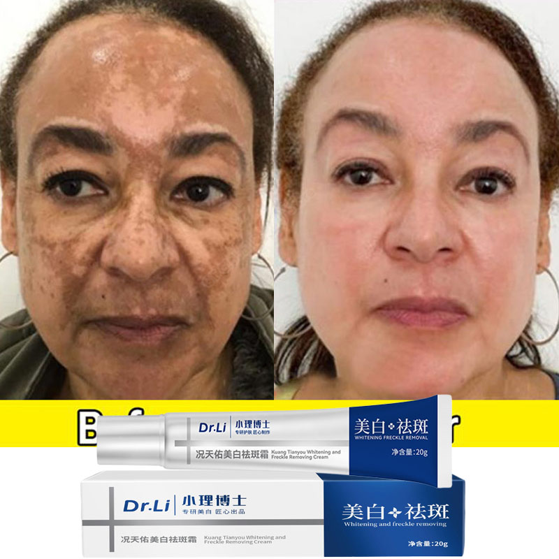 Best of Effective Whitening Freckles Cream Remove Melasma Dark Spots Fade Pigmentation Moisturize Brighten Face Korean Skin Care Product Reviews & Tips