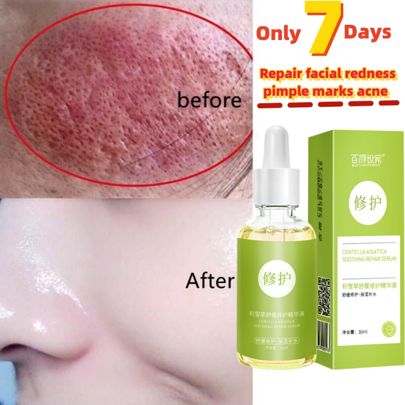 Best of 7 Day Repair Redness Serum Sooth Itching Sensitive Skin Improve Rosacea Shrink Pore Smooth Nourish Facial Skin Korean Cosmetics Reviews & Tips