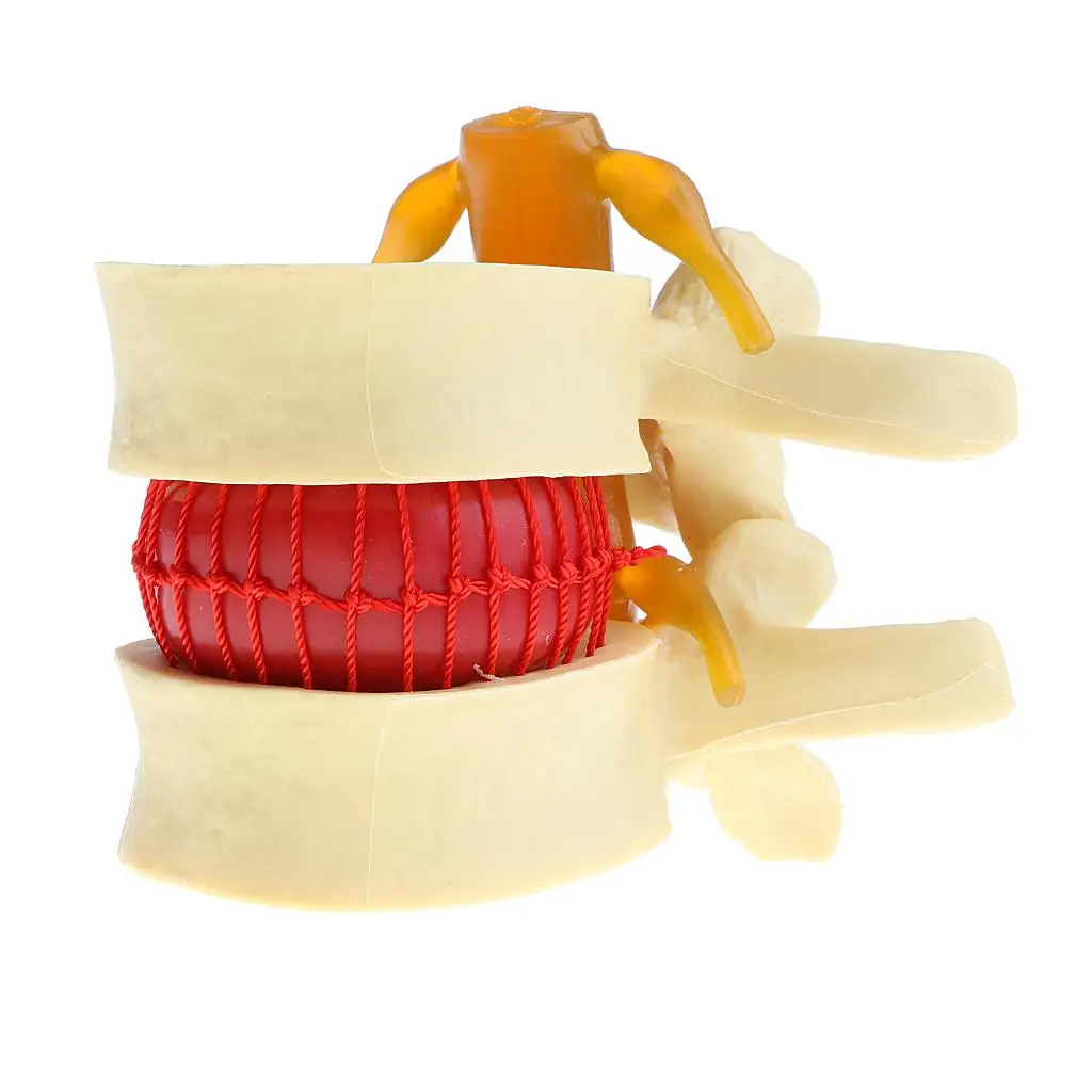  Human Spine  Vertebrae Degenerative  Disc Herniation Demonstration Model,  Teaching Tools, Magnified 2 Times