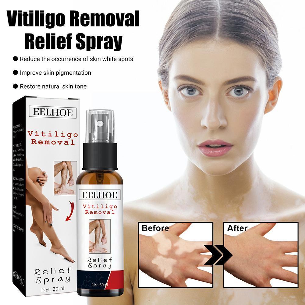 Best of 30ml Vitiligo Repair Spray Skin Moisturizing Vitiligo Body Vitiligo Fades Remove Relief Net Face Skin White Spot Spray Spot K6C3 Reviews & Tips