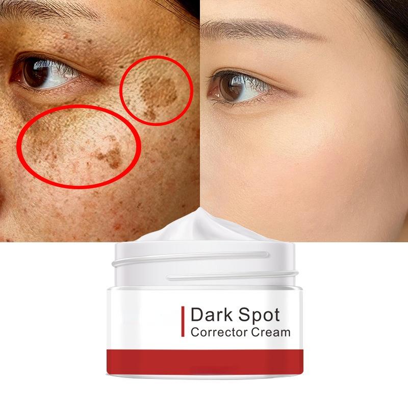 Best of Effective Whitening Freckle Cream Remove Melasma Acne Spot Pigment Melanin Dark Spots Pigmentation Moisturizing Gel Skin Care Reviews & Tips