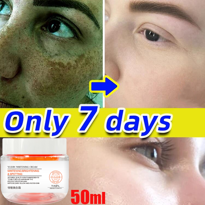 Best of Powerful Whitening Freckle Cream Remove Melasma Cream Remove Dark Spots Melanin Melasma Remover Brighten Anti-Aging Skin Care Reviews & Tips