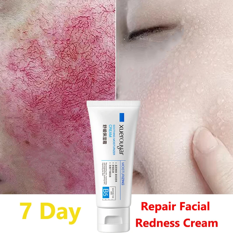 Best of B5 Facial Redness Repair Cream Rosacea Ance Treatment Repair Sunburn Soothing Sensitive Skin Moisturize Skin Care Korean Product Reviews & Tips