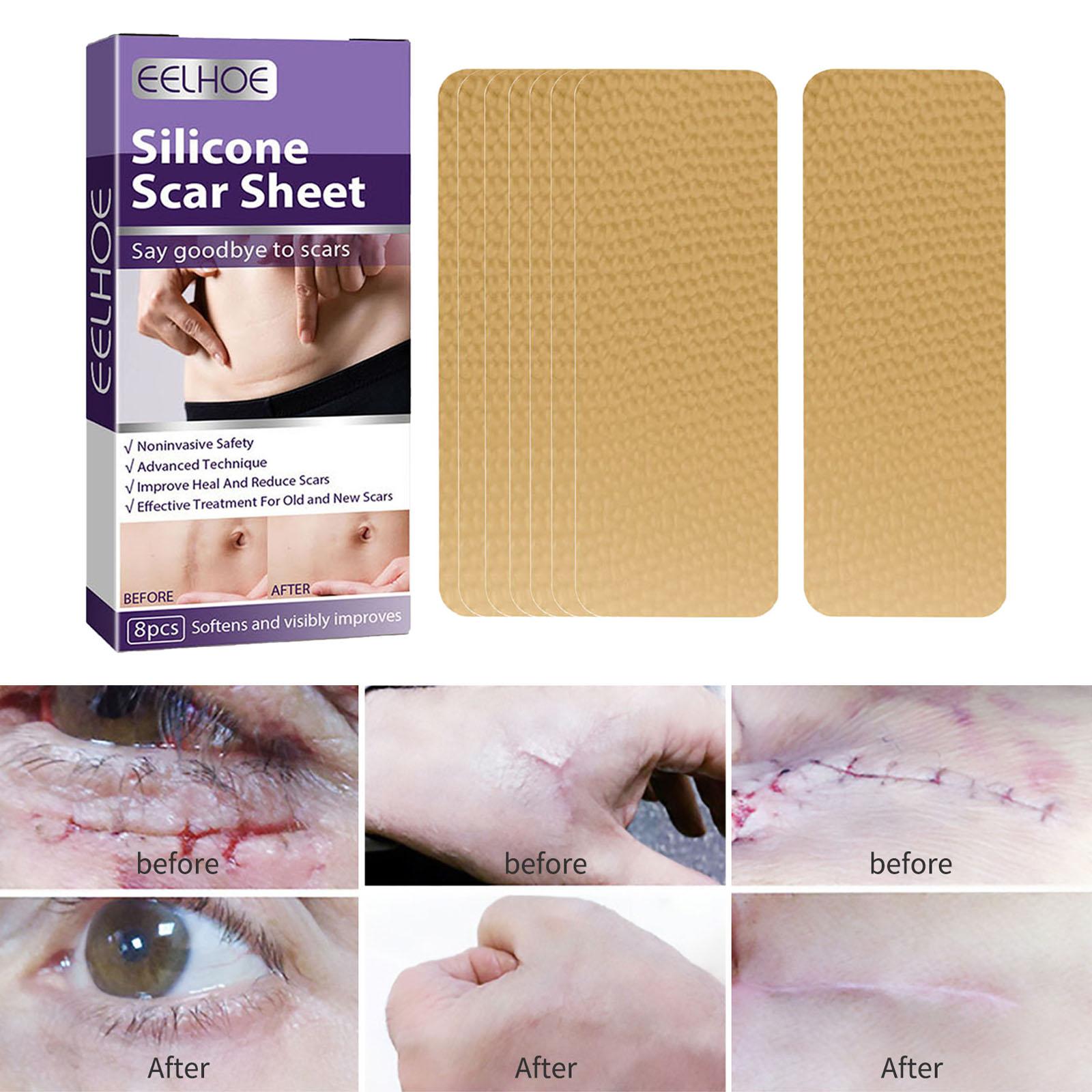 Scar Removal Silicone Scar Strips, for Burn Scars Acne Scars Keloid Scars Soft Scar Patch Comfortable Stretch Mark Reducer