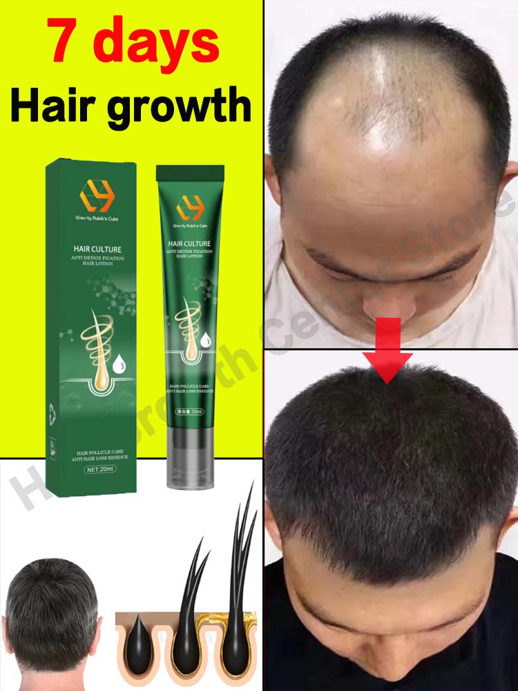 Best of Hair Growth Oil Fast Hair Growth Effective Baldness Repair Hereditary Hair Loss Postpartum Hair Loss Seborrheic Hair Loss Reviews & Tips