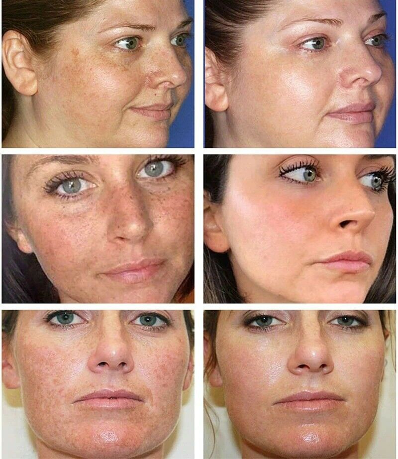 Best of Skin Face Whitening Freckle Cream Remove Melasma Acne Pigment Melanin Dark Spots Anti Freckle Cream Fade Pigmentation Brighten Reviews & Tips - Image 3