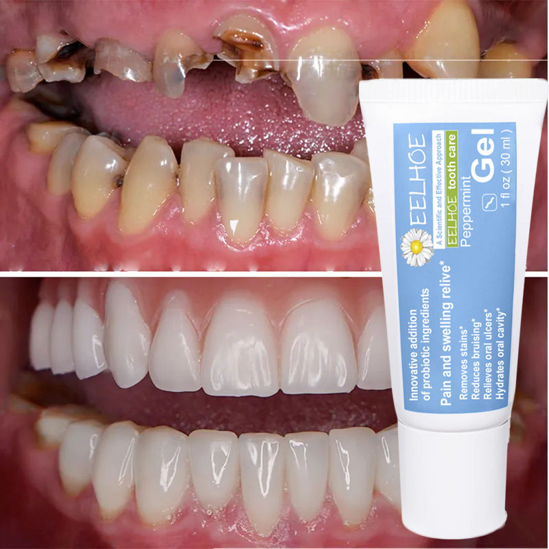 Best of High Quality Anti-cavity Toothpaste Gel Decay Fresh Breath Repair Tooth Decay Remove Plaque Relieve Toothache Periodontity Reviews & Tips