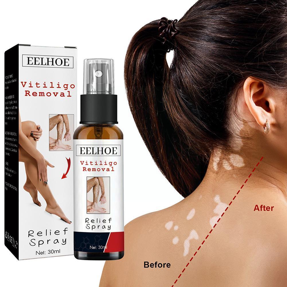 Best of 30ml Vitiligo Relief Spray Skin Moisturizing Vitiligo White Face Spray Net Repair Spot Fades Spots Vitiligo Body Repair Ski E5X2 Reviews & Tips