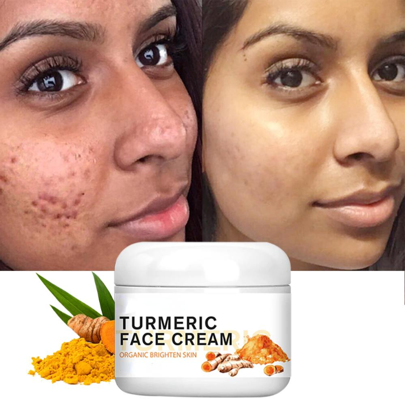 Best of Turmeric Face Whitening Cream For Dark Skin Remove Acne Lighten Dark Spots Moisturizing Brightening Cream For Face Skin Care Reviews & Tips