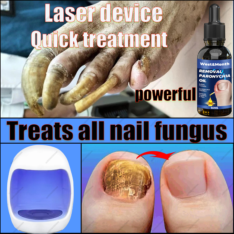 Best of Fungal Nail Laser Device Repairs Fast Nail Fungus Onychomycosis With Effective Results In 7 Days Reviews & Tips