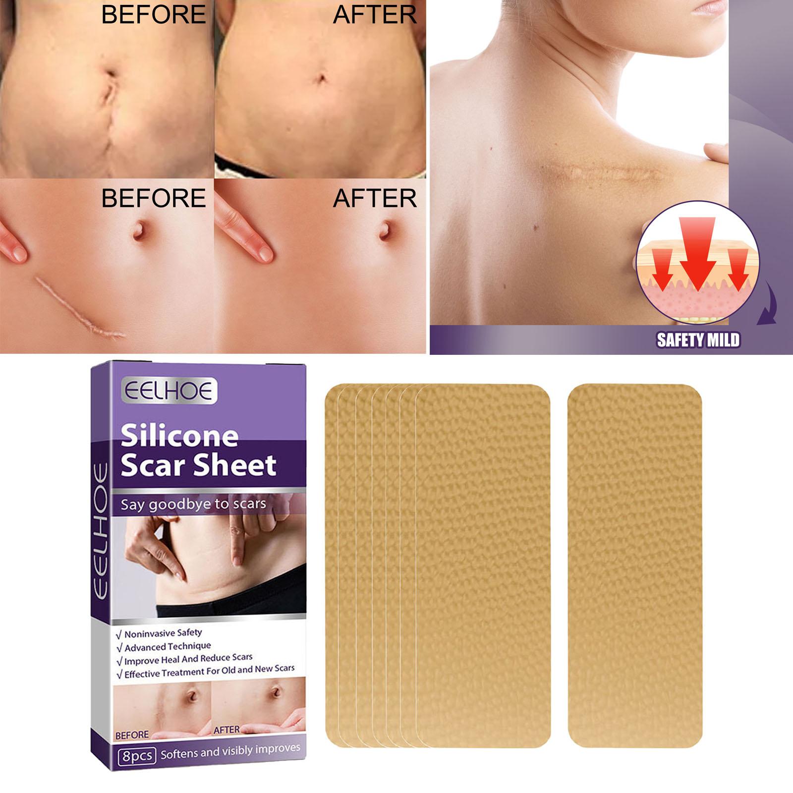 Scar Removal Silicone Scar Strips, for Burn Scars Acne Scars Keloid Scars Soft Scar Patch Comfortable Stretch Mark Reducer