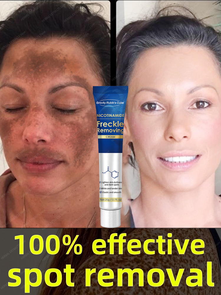 Best of Dark Spot Remover For Face Cream Black Age Sun Spots Freckle Melasma Reviews & Tips