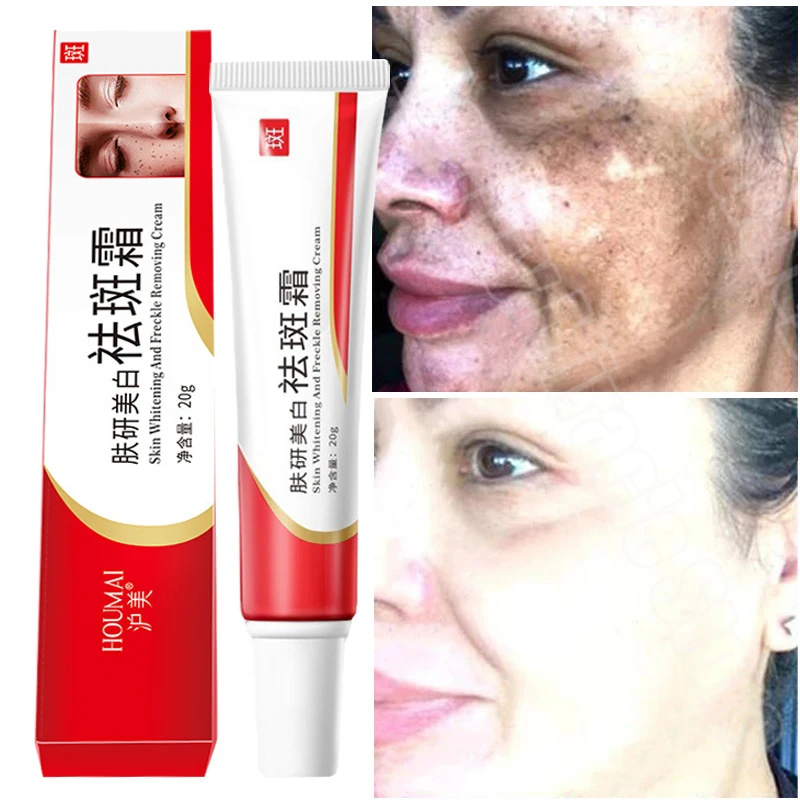 Best of Dark Spot Corrector Face Cream Remove Melasma Chloasma Senile Plaques Whitening Repair Cream Lightening Freckle Korean Cosmetics Reviews & Tips